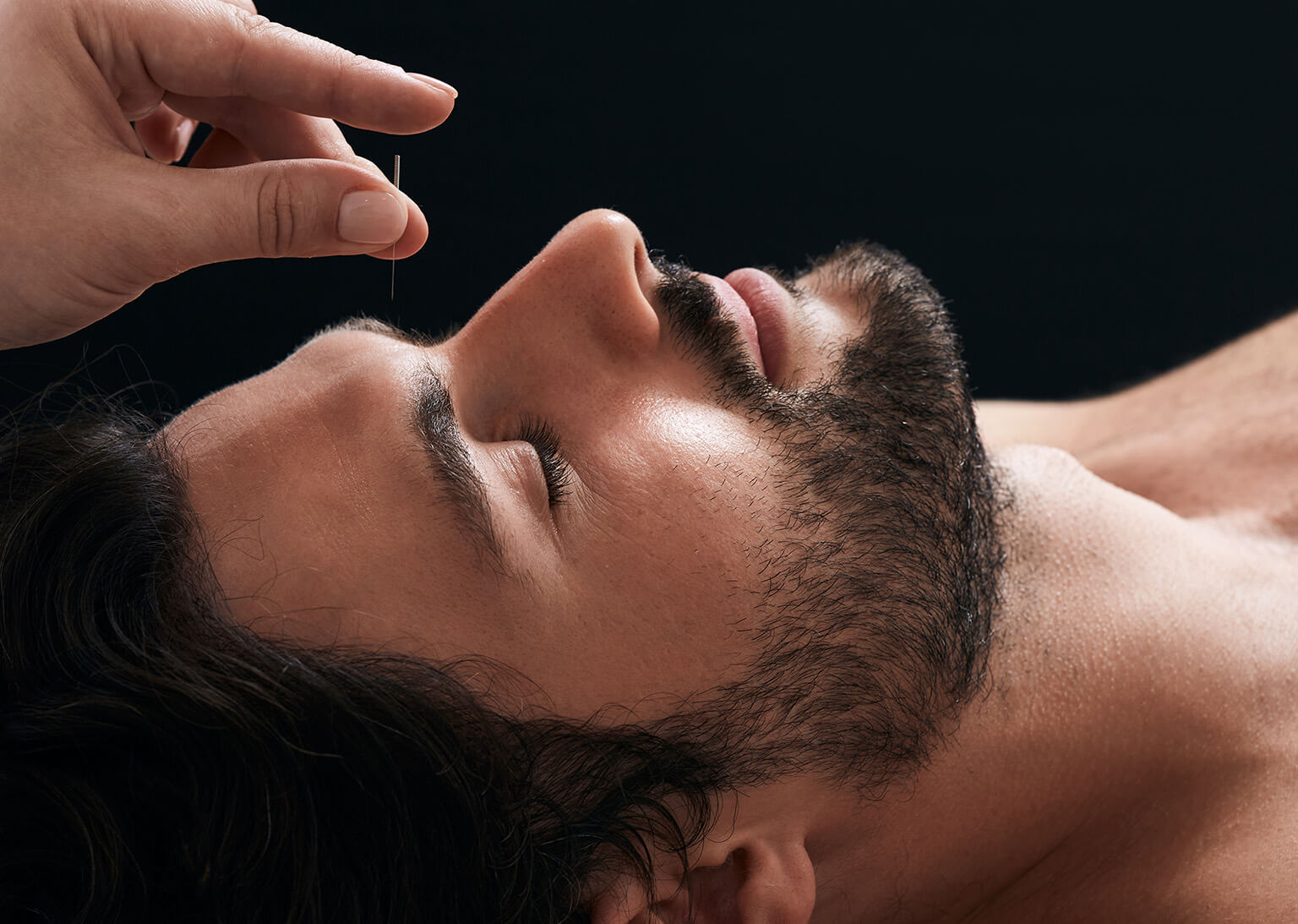 Acupunctuur bij migraine